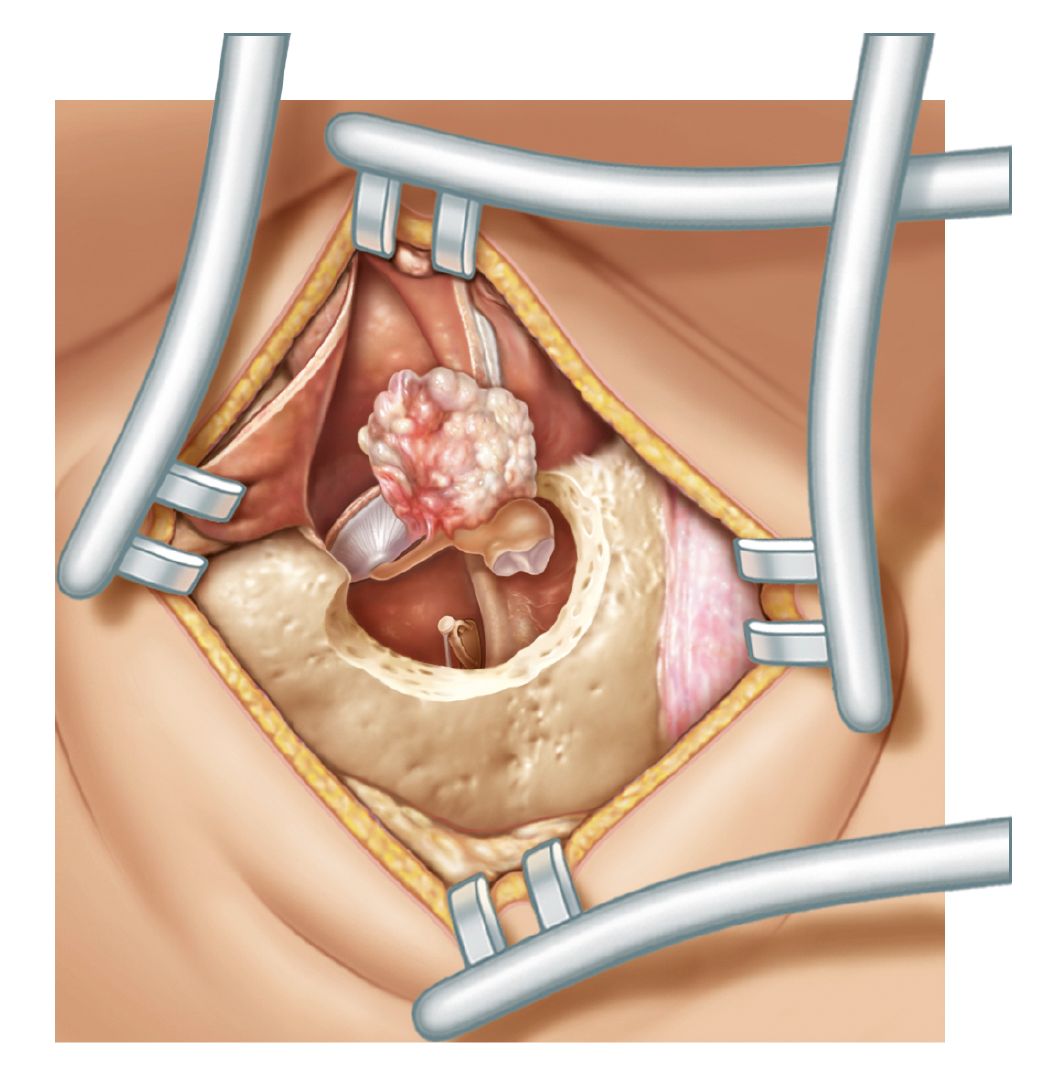 Illustration of the surgical exposure of a cholesteatoma.