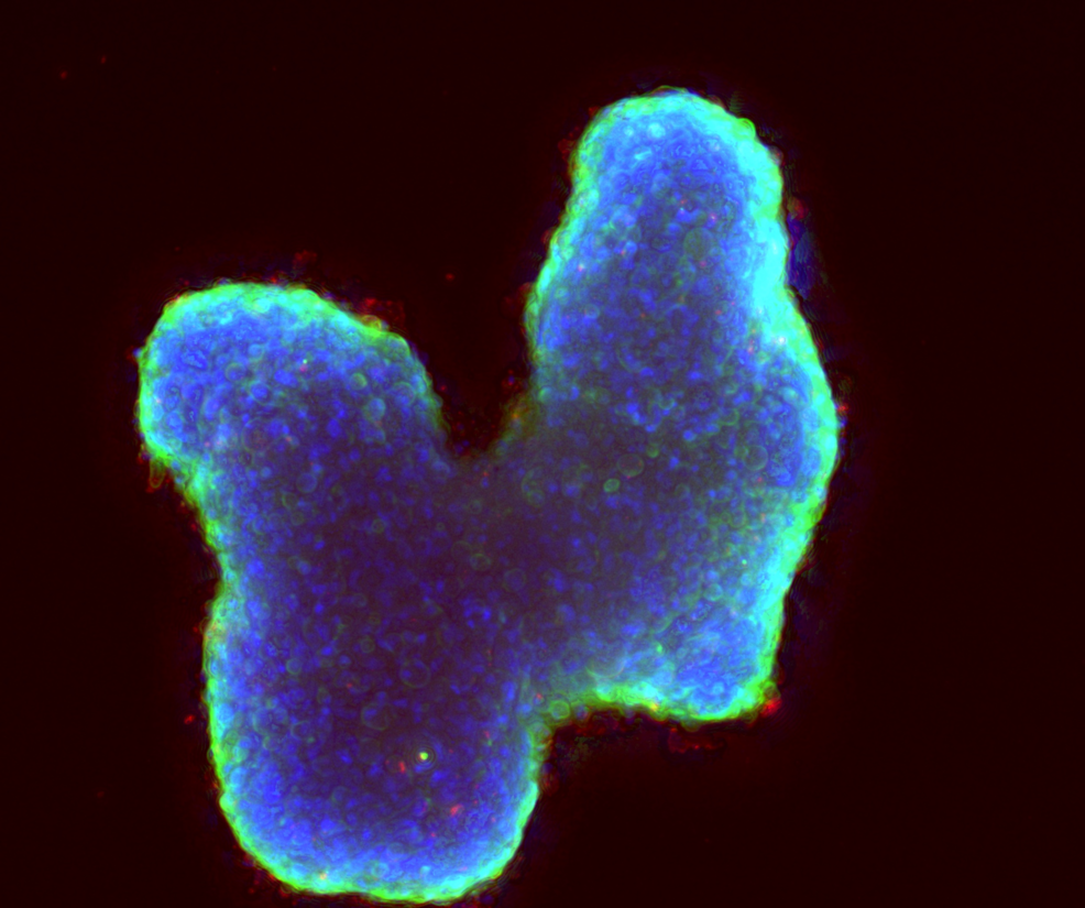 Mikroskop-Aufnahme eines künstlich gezüchteten Tumors vor schwarzem Hintergrund. Das Zellgewebe ist unregelmäßig geformt und erinnert an eine dreidimensionale, wellige Masse. Das Innere des Tumors leuchtet intensiv blau, während die gesamte äußere Oberfläche von einem hellen, neongrünen Rand umschlossen wird. An den Rändern sind vereinzelte, winzige rote Punkte zu erkennen.
